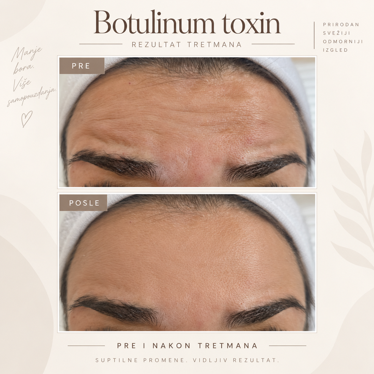 Pre i posle rezultat botulinum toxin tretmana