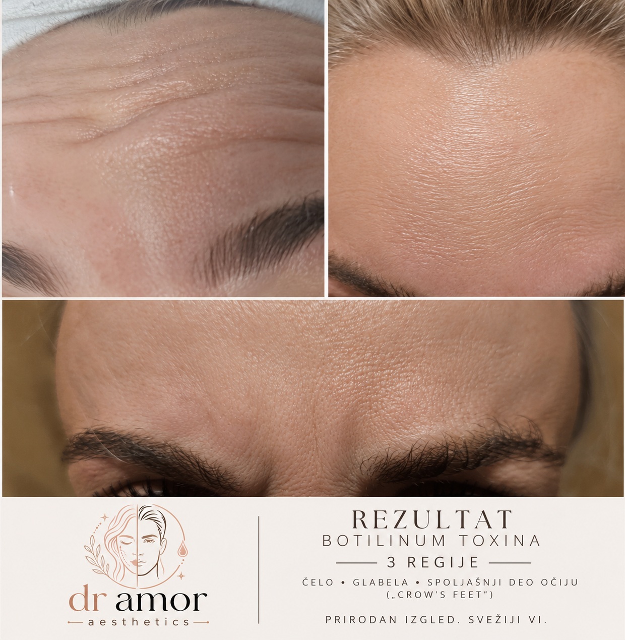 Pre i posle botox 3 regije