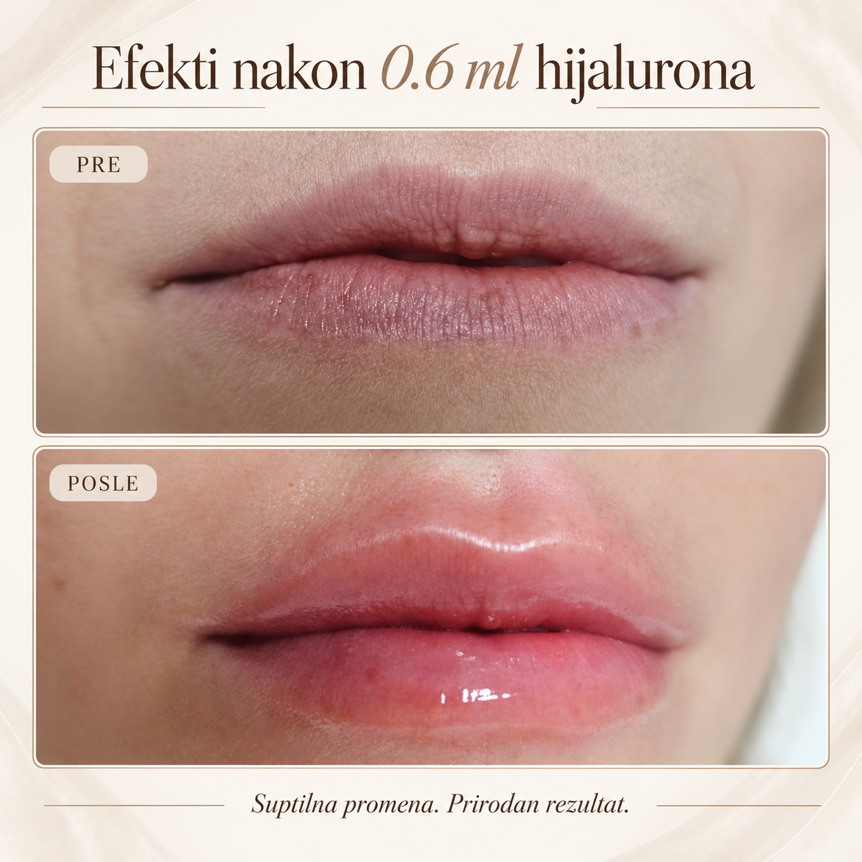 Pre i posle rezultat hijalurona usana 0.6 ml