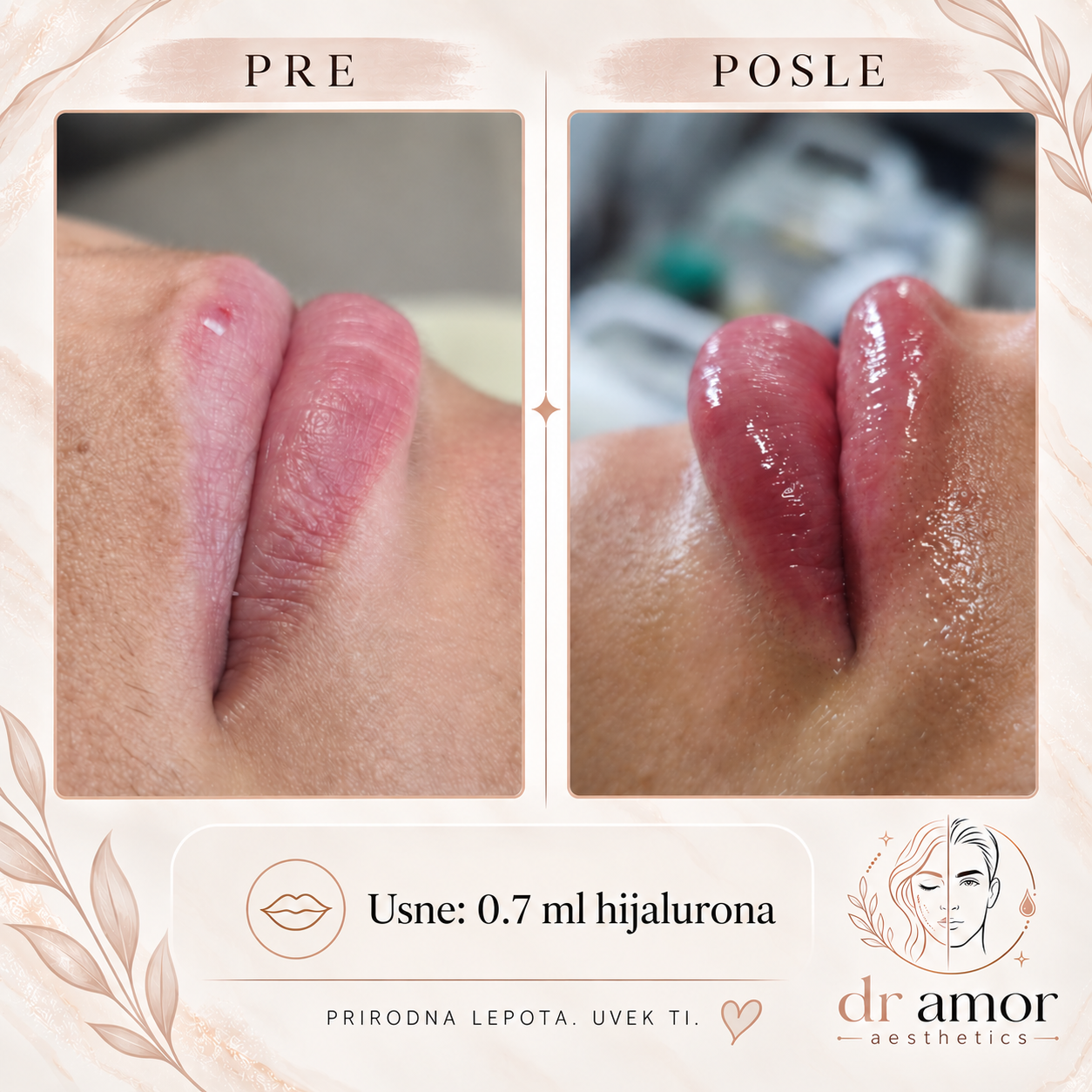 Pre i posle rezultat hijalurona usana 0.7 ml