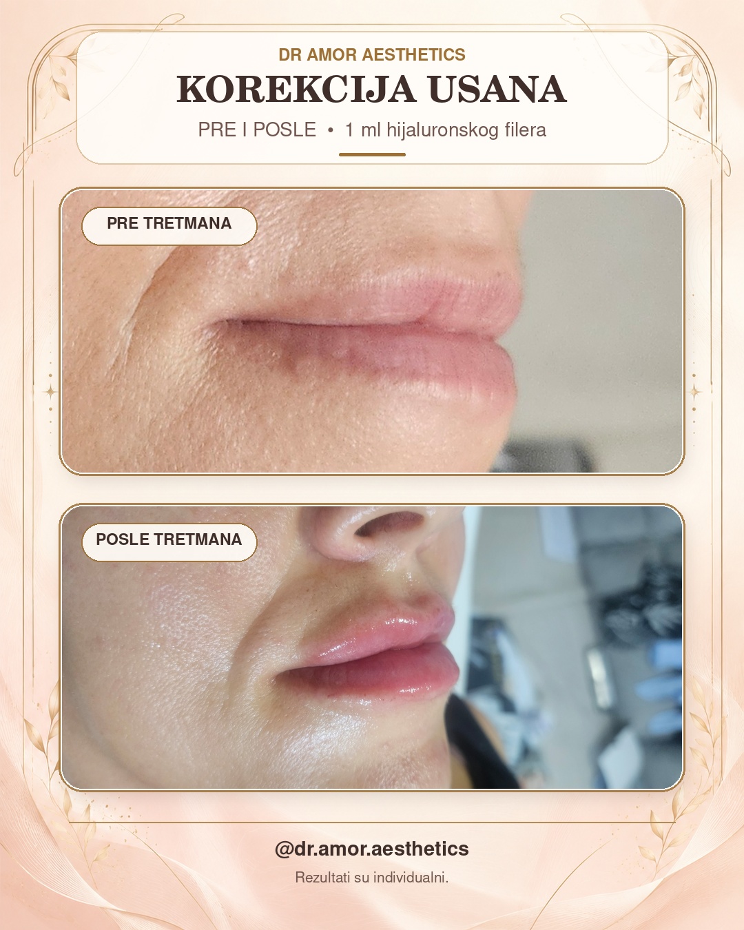 Pre i posle korekcija usana 1 ml hijalurona